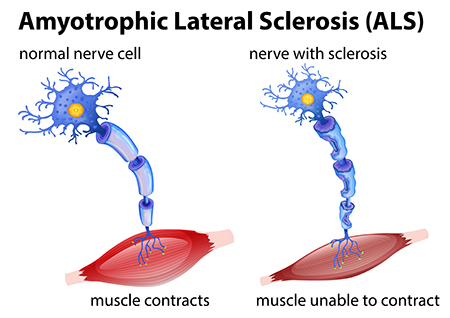 Diagram of the difference between healthy neurons and those in a person with ALS